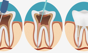 Root Canal Therapy